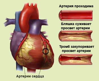 Ишемическая Болезнь Сердца Реферат Кратко