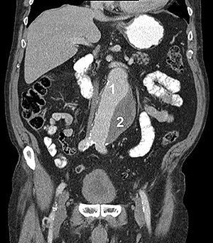 аневризма аорти