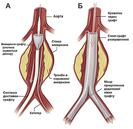 аневризма аорти