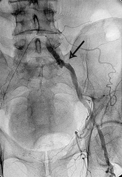 відновлення отвору клубової артерії