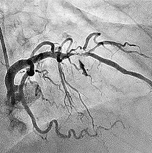 стеноз лівої коронарної артерії