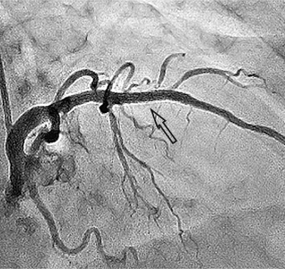 відновлення отвору коронарної артерії