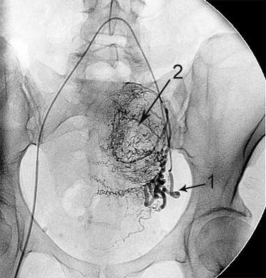 міома матки до емболізації
