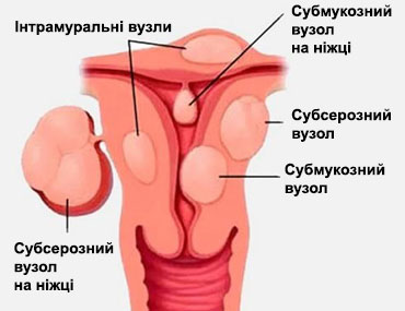 вузли міоми