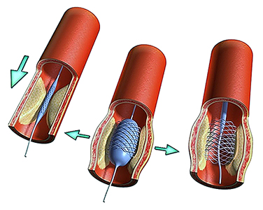 стентування