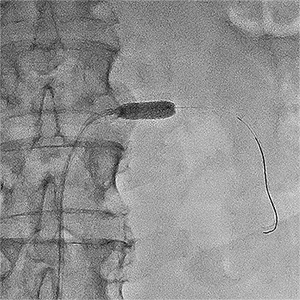 балон, роздутий в зоні стенозу
