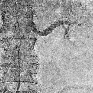 відновлення отвору артерії