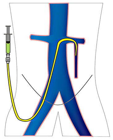 проведення катетера в яєчкову вену