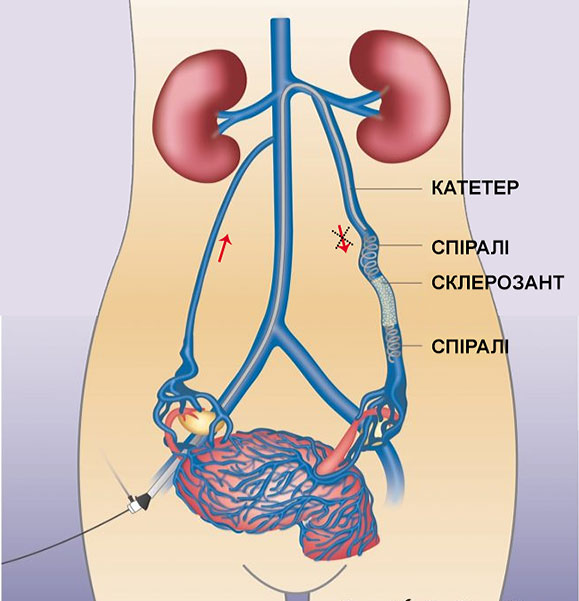 стентування